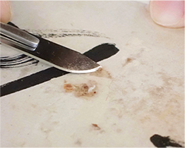 手術刀尖小心挑除髒污及異物